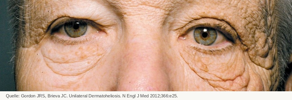 Nahaufnahme der Augenpartie eines Lkw-Fahrers mit einseitiger Hautalterung durch jahrelange UV-Strahlung, NEJM 2012